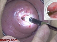 Endoscope With Camera Is Inserted Into The Cervix To See Inside