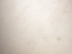 Burning Pubic Hair