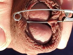 Safety pin in foreskin