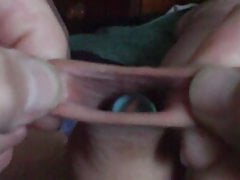 Spoon or ball or phone in foreskin - 36 minutes