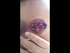 Asshole extrem anal prolaps gape