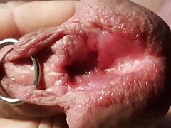 Subincision