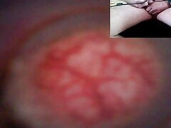 Trip down the urethra with two cameras