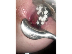 Extreme anal insertion